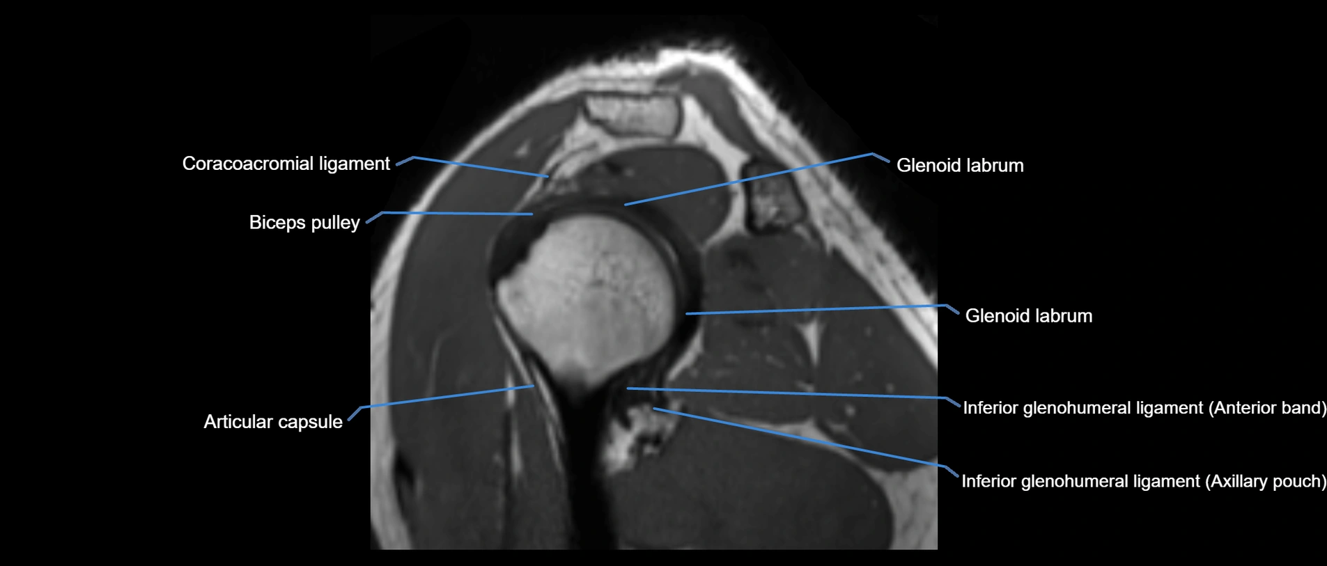 shoulder ligaments sagittal  cross sectional anatomy 3T MRI AI enhanced radiology image -img-00001-00032.webp